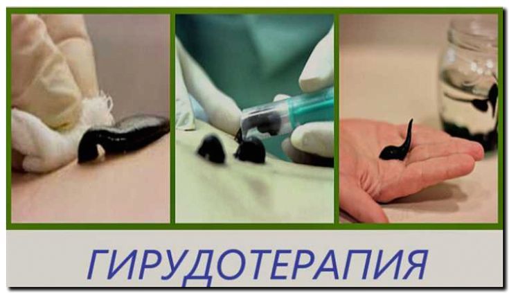 Реклама и продвижение гирудотерапии