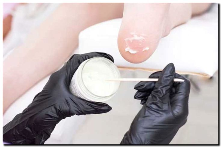 Реклама и продвижение лечения гиперкератоза