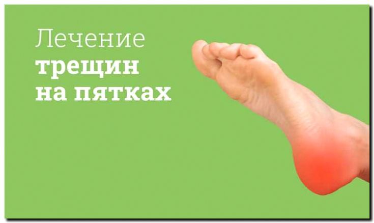 Реклама и продвижение лечения трещин на стопах