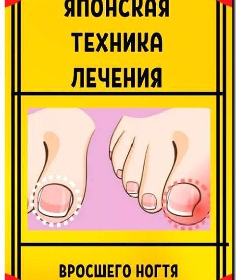 Реклама и продвижение лечения вросшего ногтя