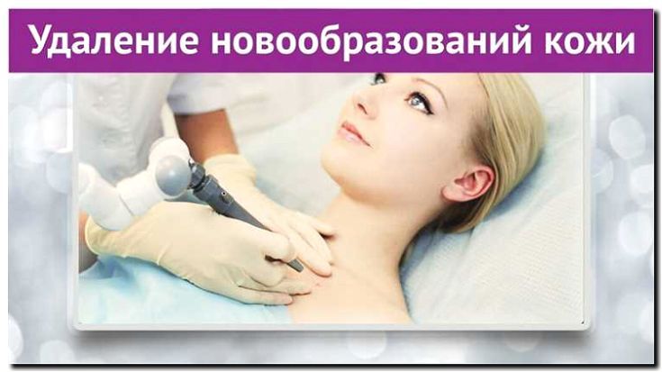 Реклама и продвижение удаления новообразований