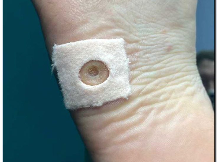 Реклама и продвижение удаления стержневых мозолей