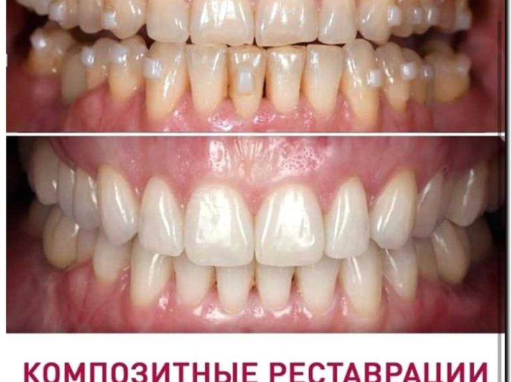 Реклама и продвижение художественной реставрации зубов